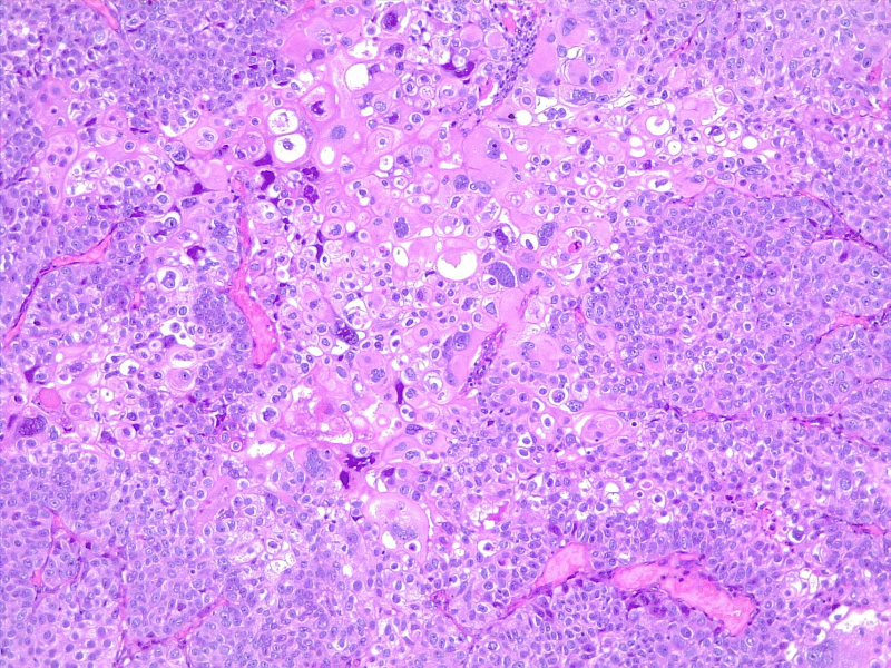 Poorly differentiated urothelial carcinoma, with metaplastic squamous appearance