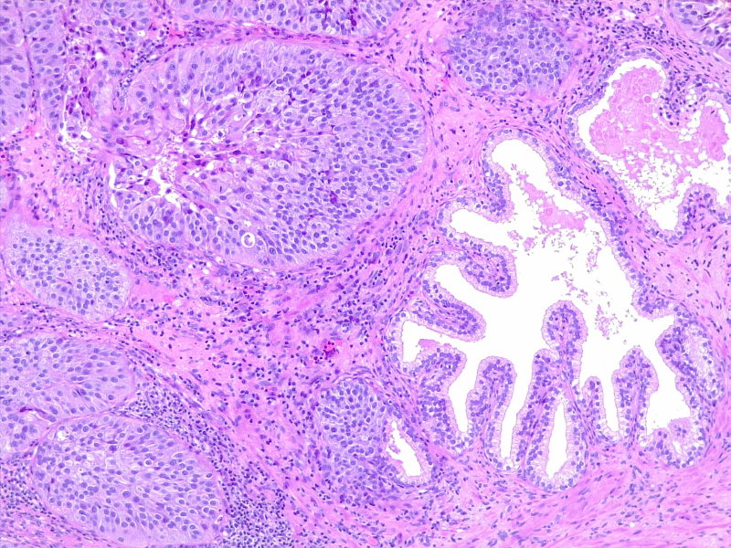 Urothelial carcinoma, prostatic infiltration