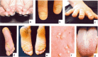 图1。 。 先天性厚甲症的常见表现包括：增厚和营养不良的指甲（手指甲和脚趾甲）(ac)； 大疱（通常在脚跟和脚底的压力点）； 角化过度 (de);  囊肿 (f);  和口腔白角化症（g）。
