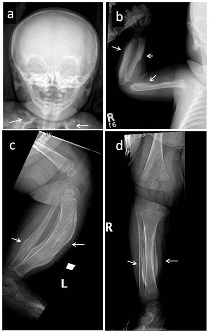 Figure 1. . Skeletal survey in a female age five weeks with the defining COL1A1 p.