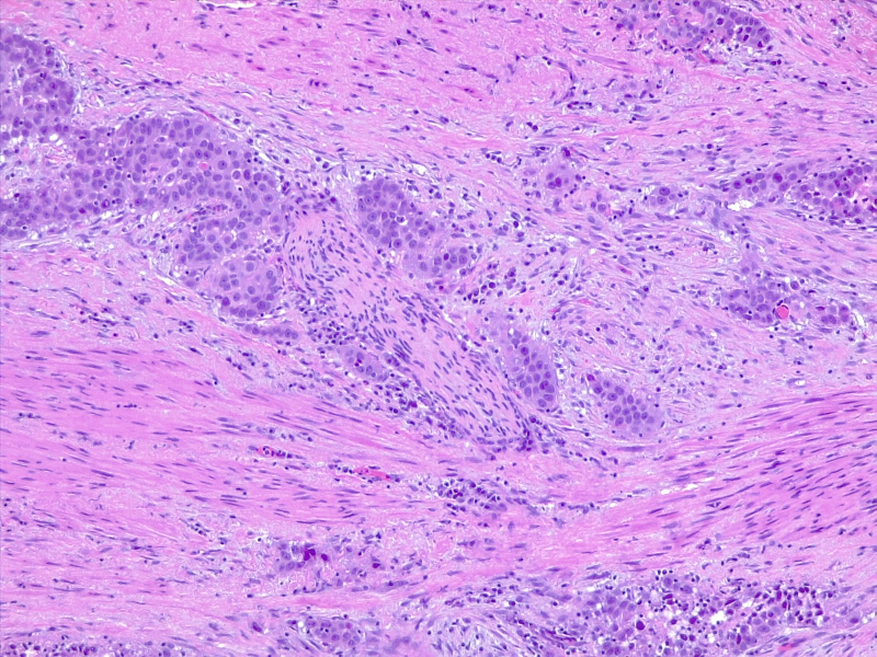 Urothelial carcinoma, perineural invasion