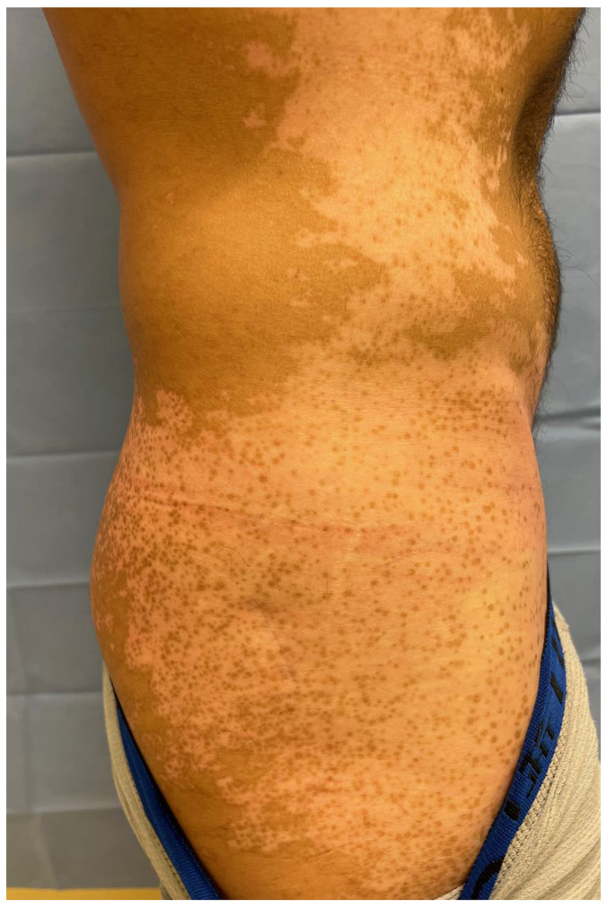 白癜风大面积毛囊周围色素沉着