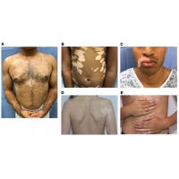 【佳学基因检测】白癜风基因检测及其靶向治疗