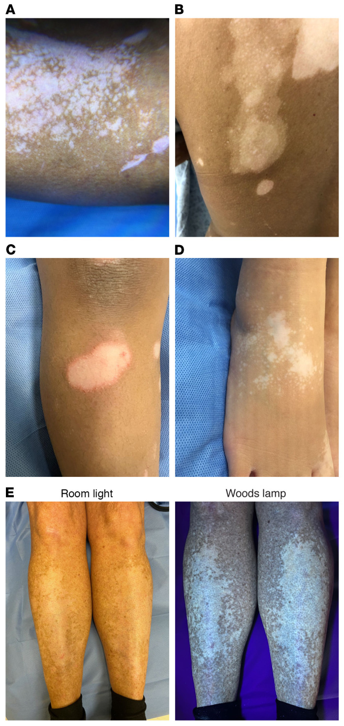 图 2. 活动性白癜风病变的临床症状及其基因检测