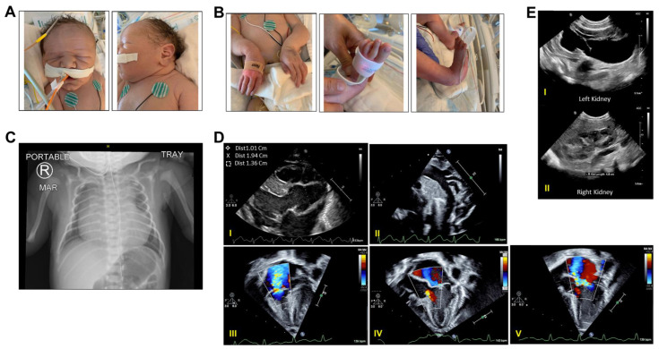 上海马方式综合征基因检测