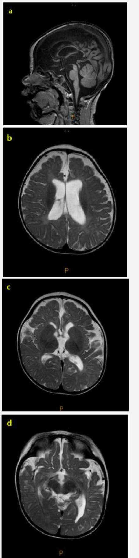 婴儿癫痫痉挛综合征基因检测MRI