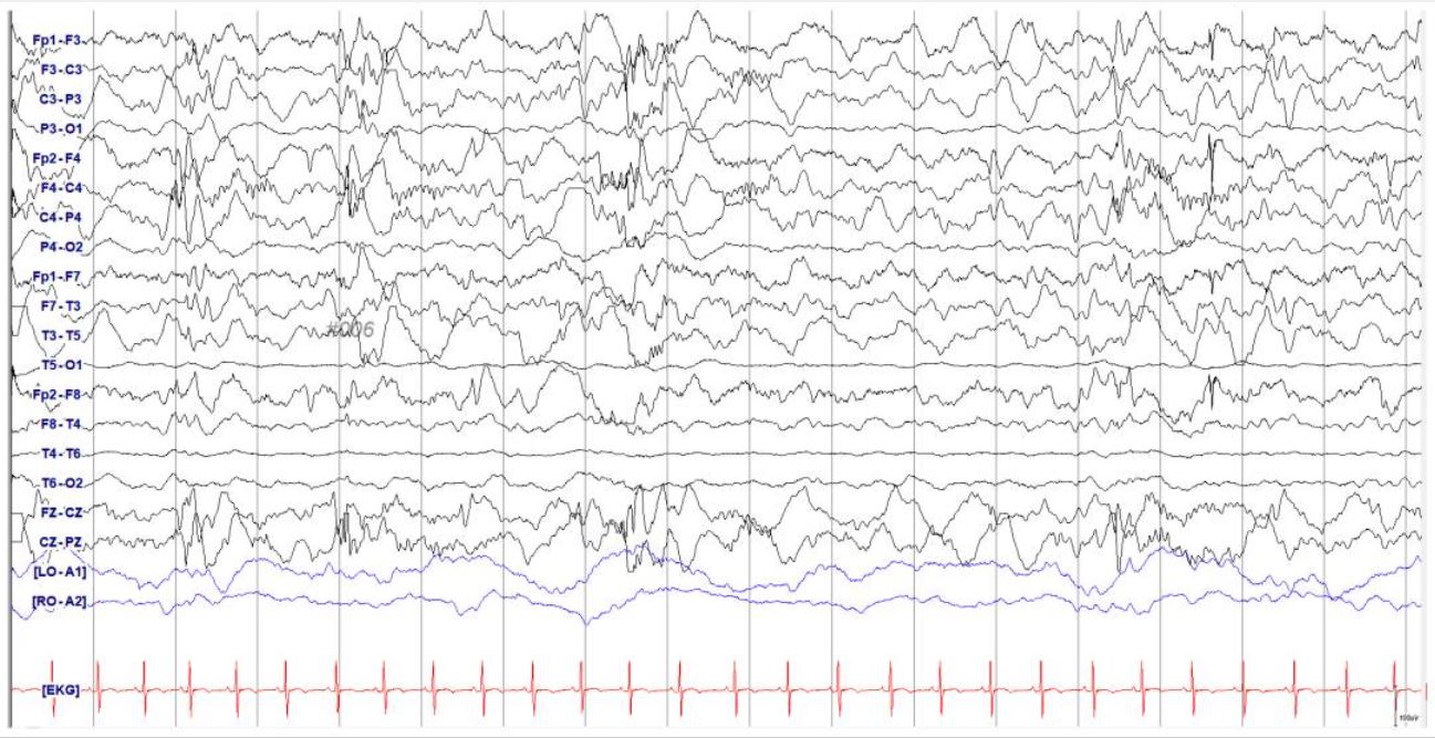 婴儿癫痫痉挛综合征脑电图基因检测