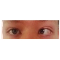 【佳学基因检测】病例结果说明<font color='red'>斜视</font>为什么要做线粒体基因检测？