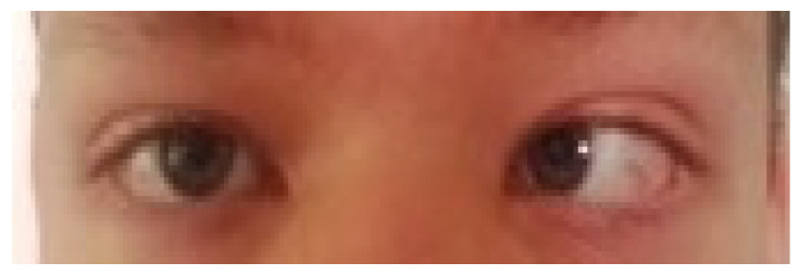 斜眼基因检测北京