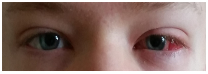 斜眼基因检测湖北